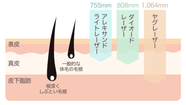 スキミークリニック脱毛器